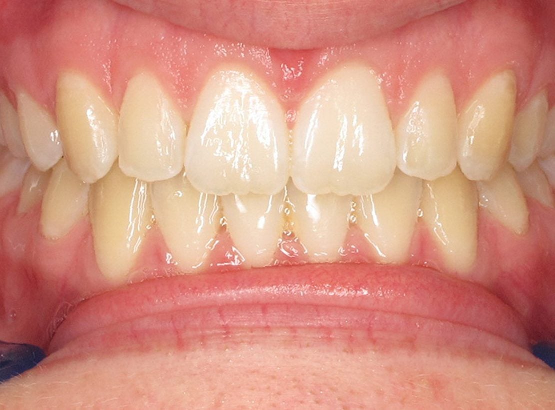 teeth after photo